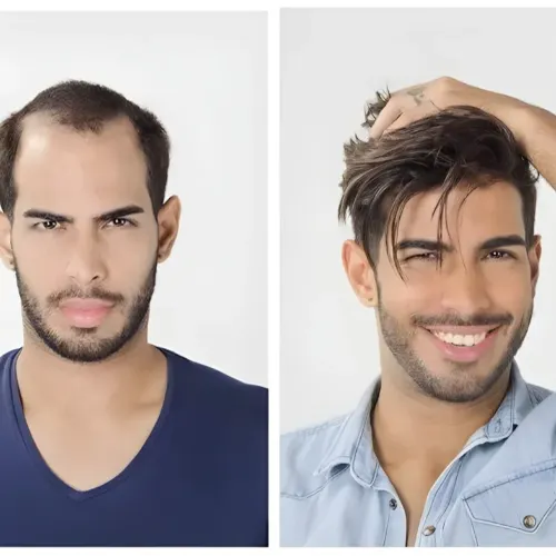 Semi-Permanent Hair Wig Fixing