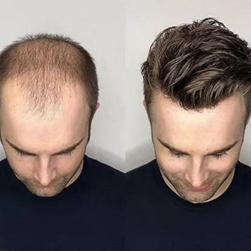 Permanent Hair Wig Fixing